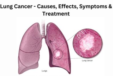 Lung Cancer - Causes, Effects, Symptoms & Treatment
